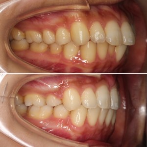 矯正するべき歯並び　噛み合わせ　口ゴボ