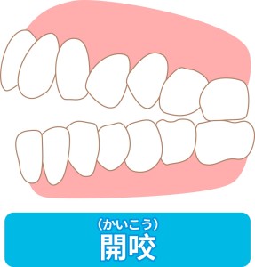 歯並び悪い　体調　影響