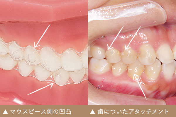 マウスピース型矯正は痛くない 横浜駅前歯科 矯正歯科