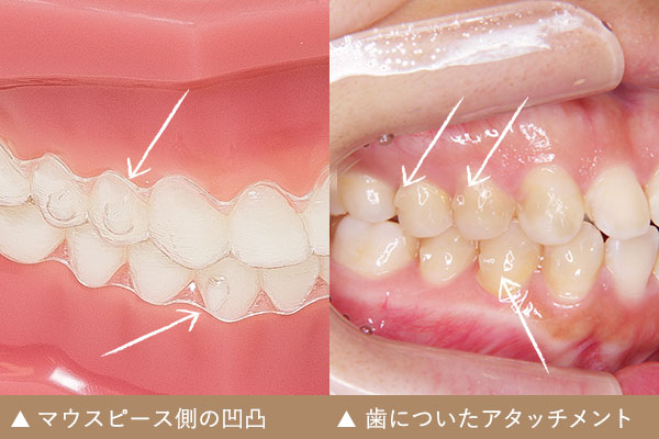 歯 列 矯正 マウス ピース