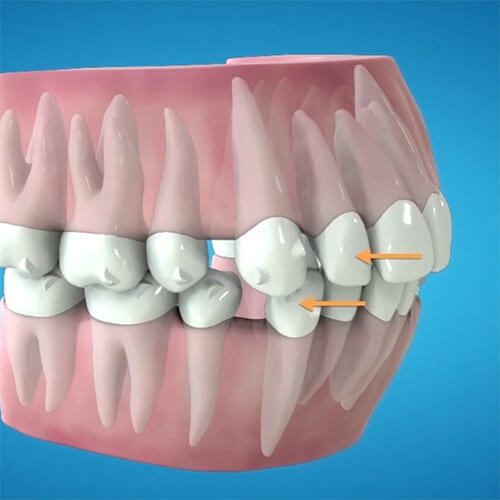 マウスピース型矯正で歯がうごくの 横浜駅1分 横浜駅前歯科 矯正歯科
