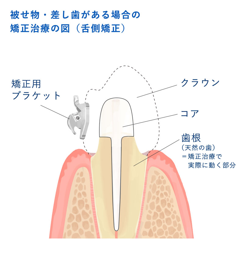 セラミック単冠と支台歯イラスト