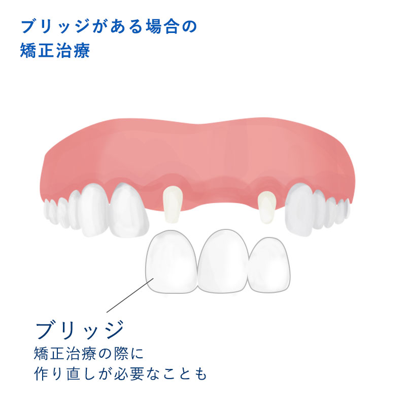 セラミック連結冠と支台歯・欠損イラスト