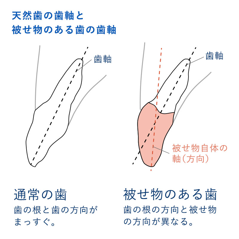 歯軸 イラスト