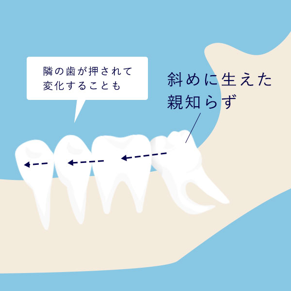 親知らずが生えている歯を押す様子