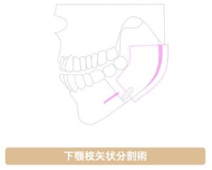 受け口　しゃくれ　矯正