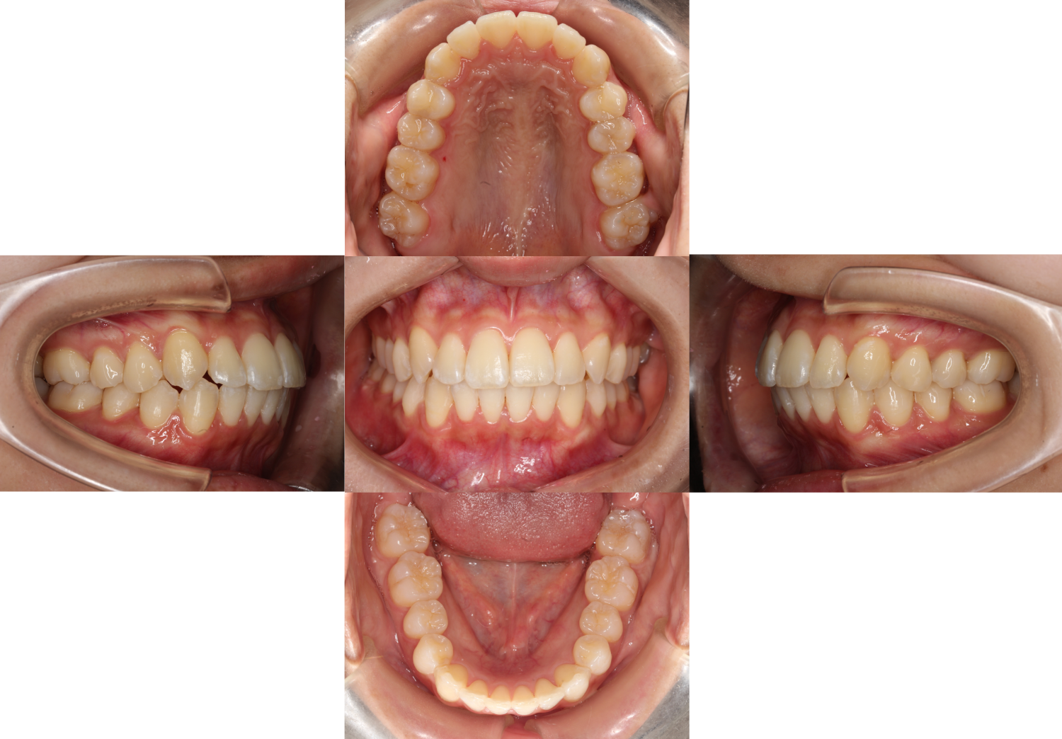 八重歯・裏側矯正の症例