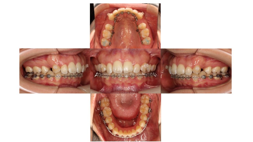 上顎前突ハーフリンガル症例