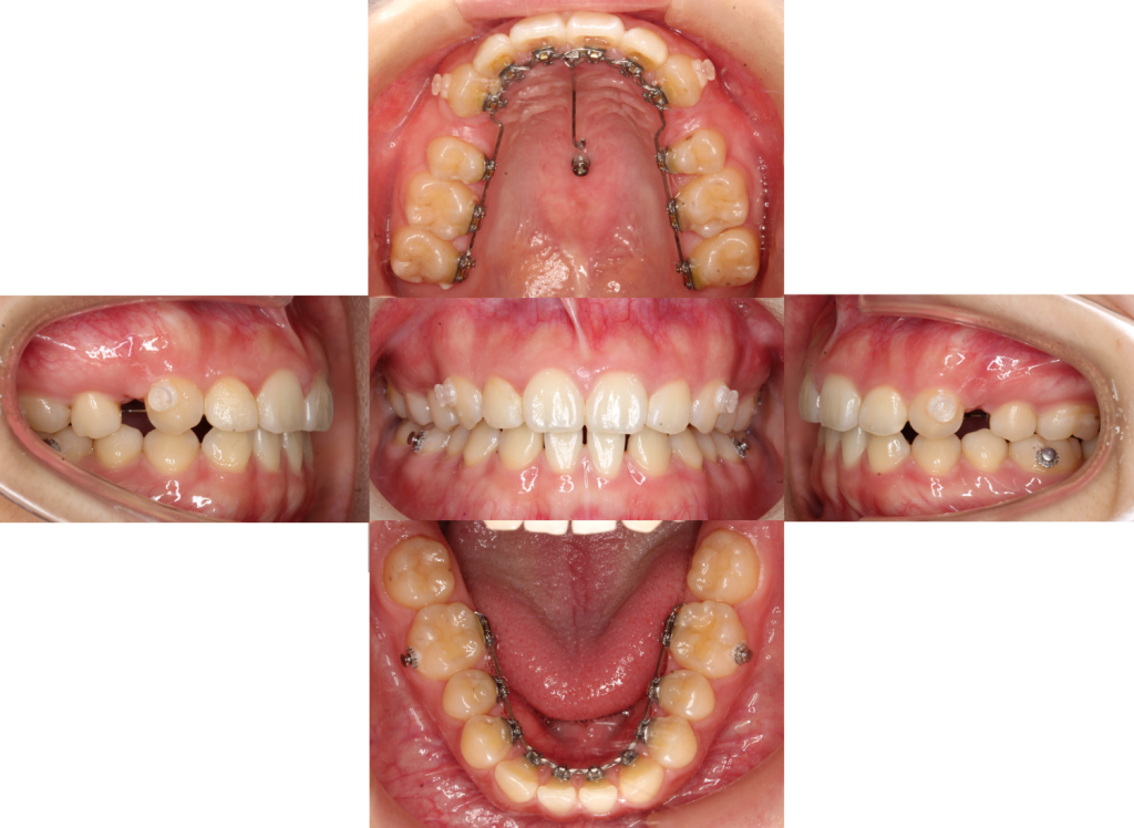 すきっ歯・裏側矯正の症例