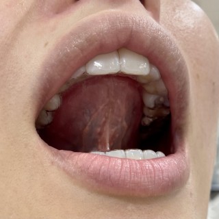 舌の正しい位置　舌の正しいポジション　横浜駅前歯科矯正歯科