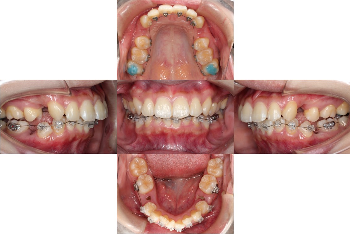 Eライン・ハーフ矯正