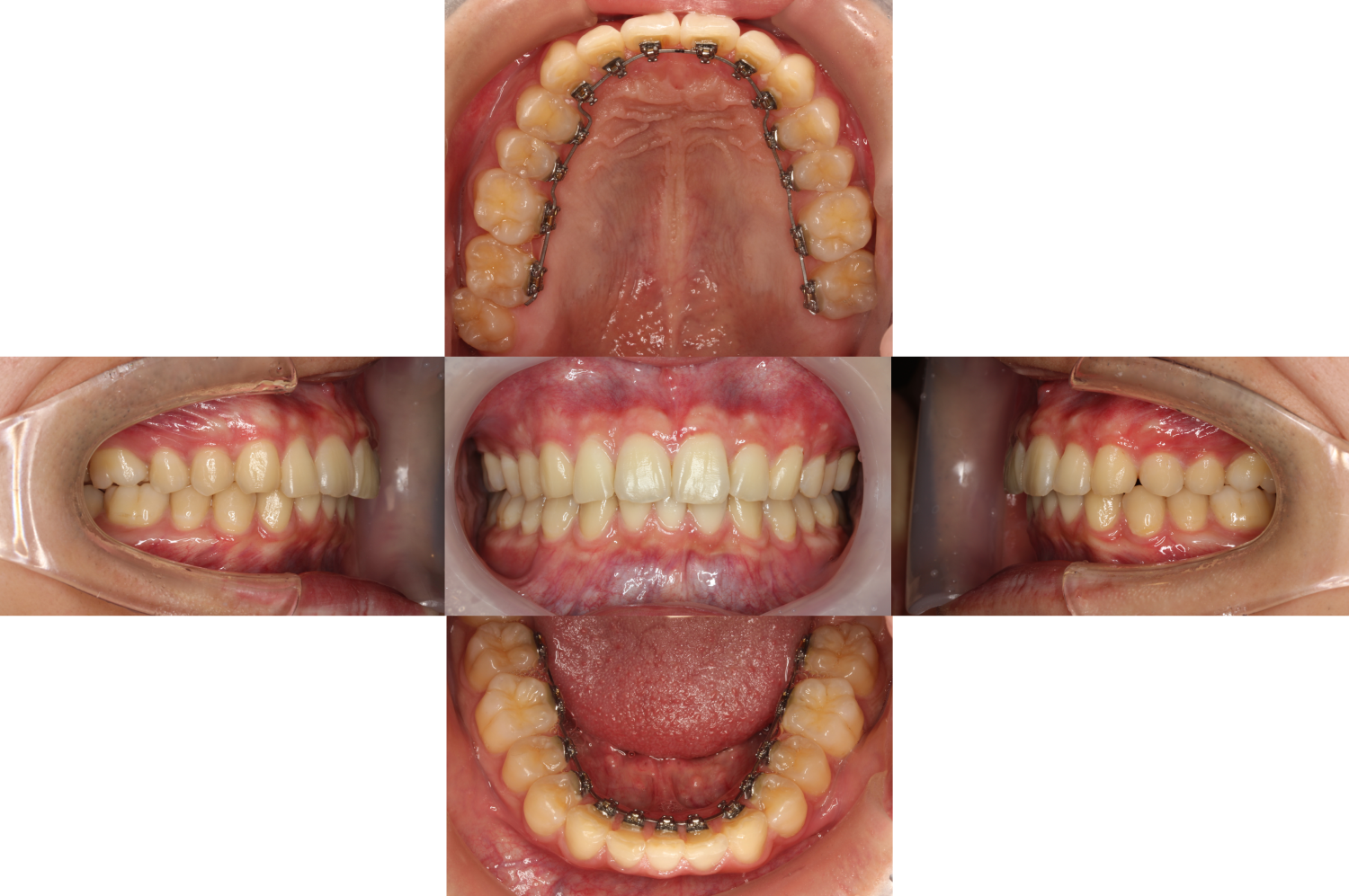 過蓋咬合・裏側矯正の症例