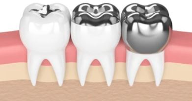 補綴歯