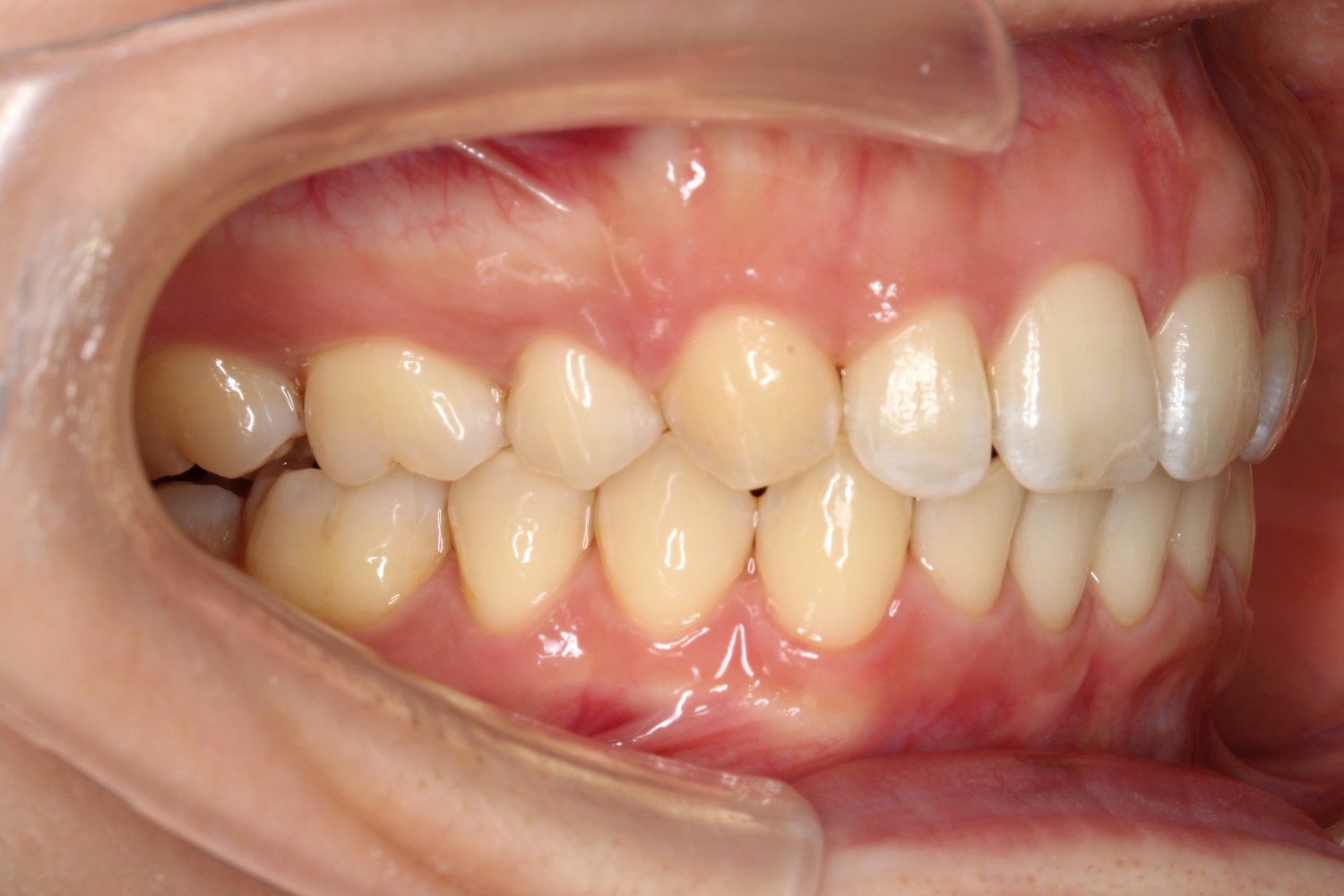 上顎前突ハーフリンガル症例