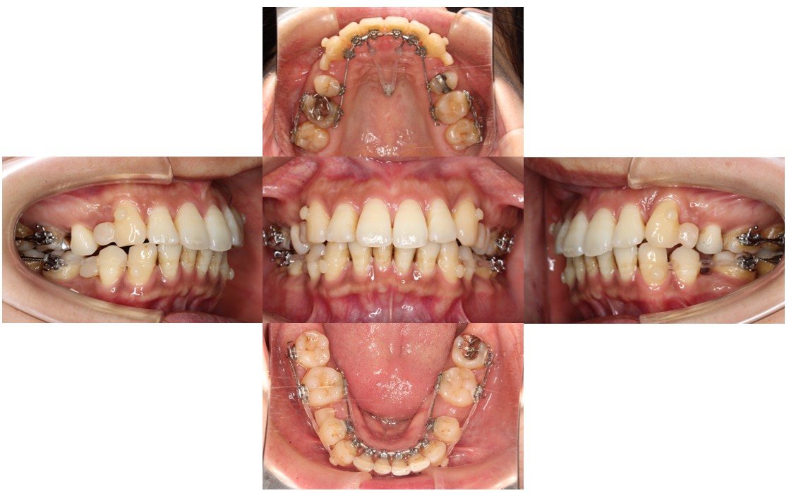 ガタガタ リンガル