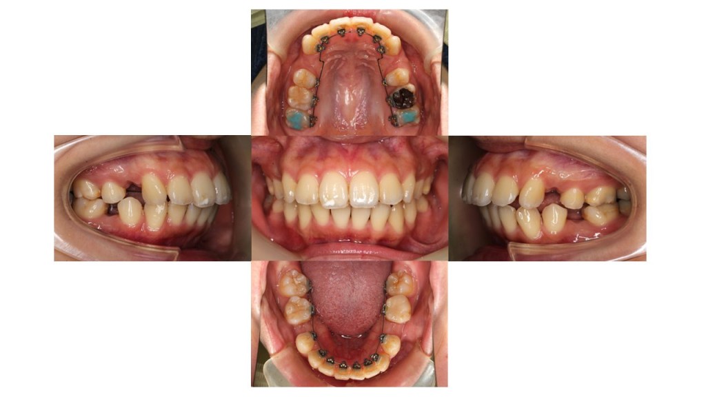 上の歯出ている、裏側矯正症例
