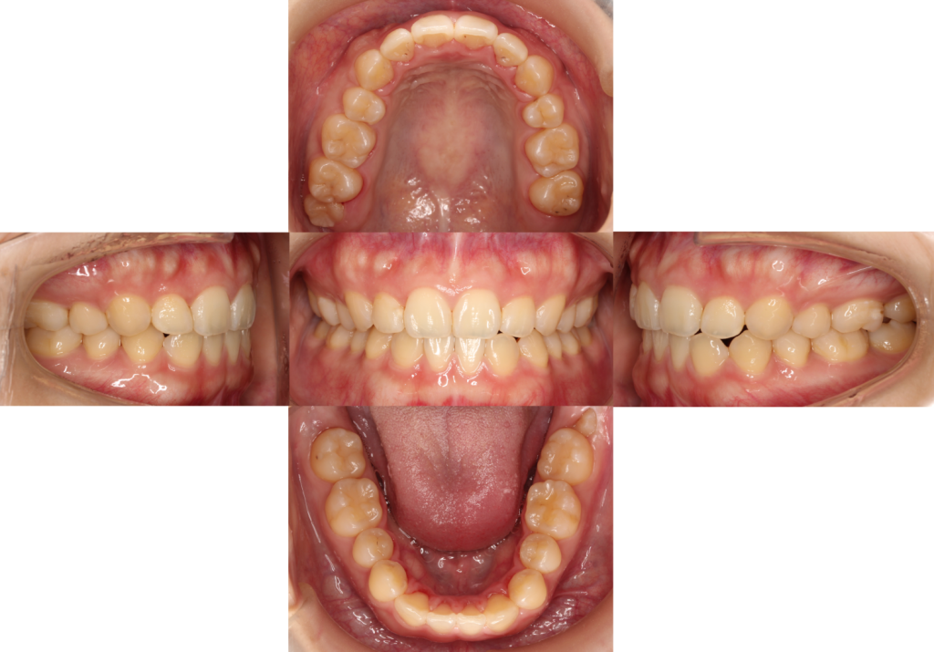 すきっ歯・裏側矯正の症例