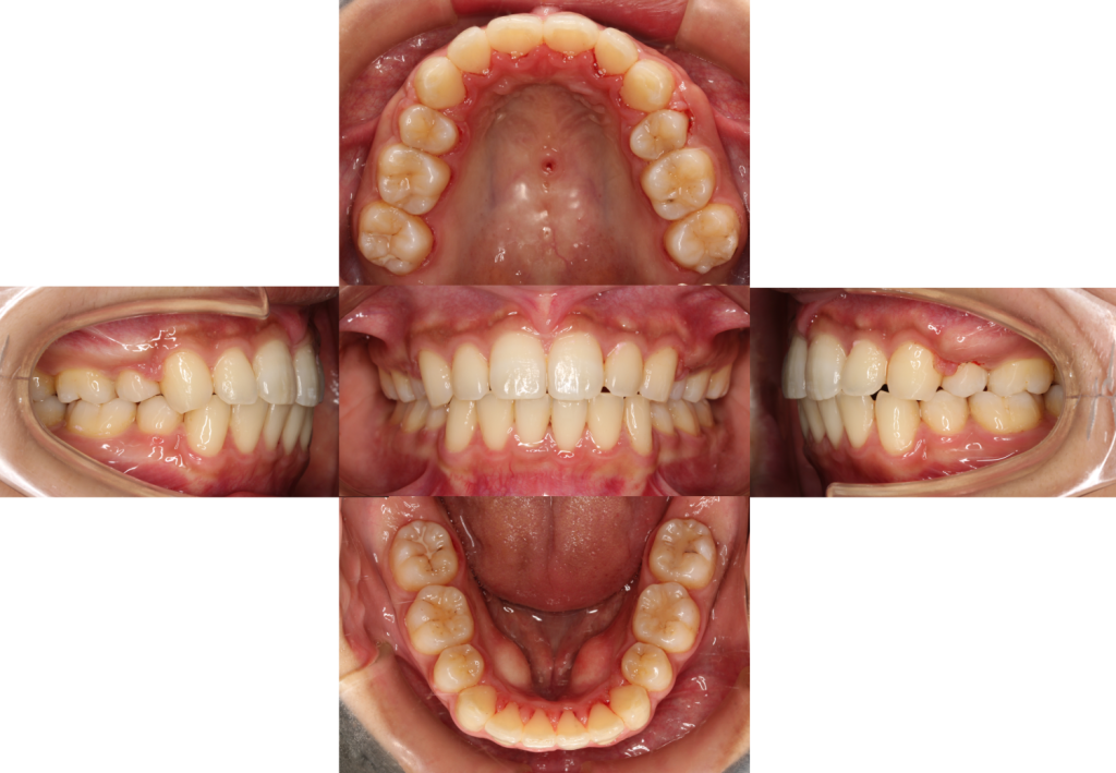 叢生・リンガル