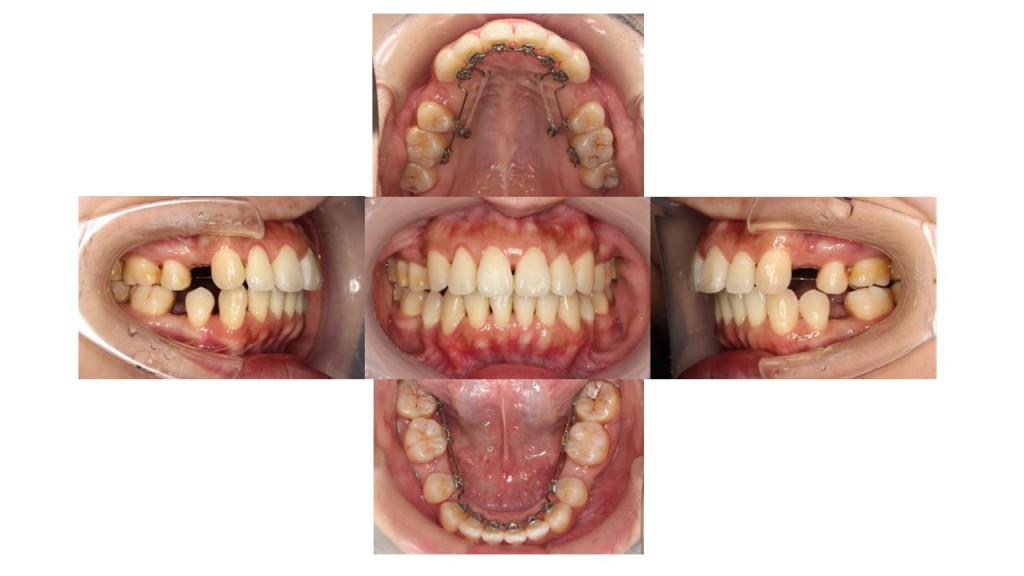 出っ歯改善・裏側矯正