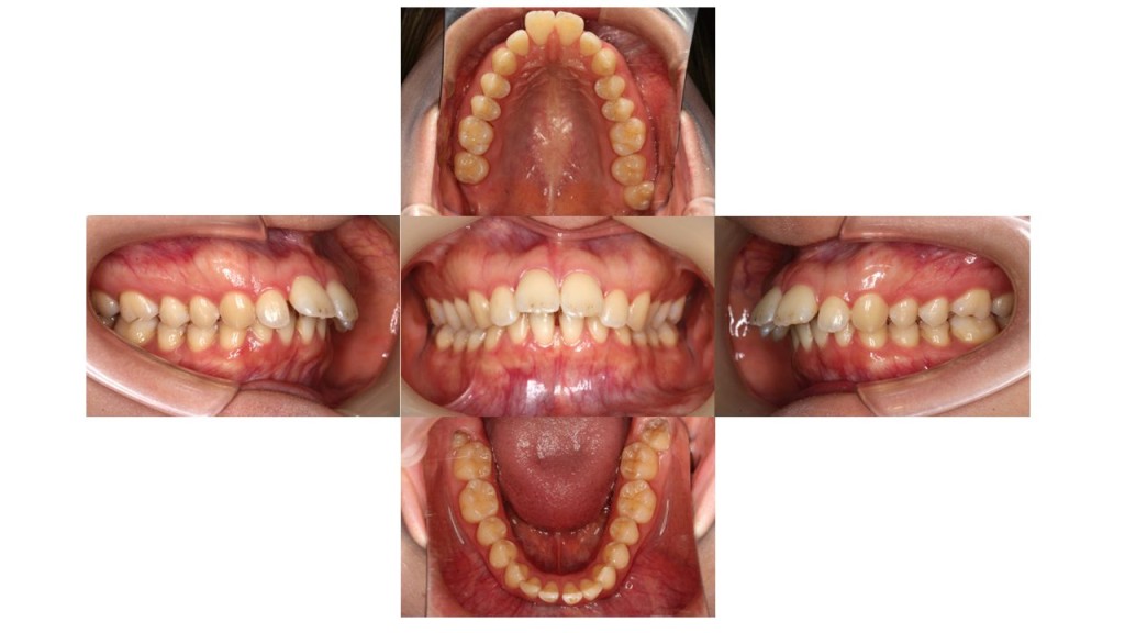上顎前突ハーフリンガル症例