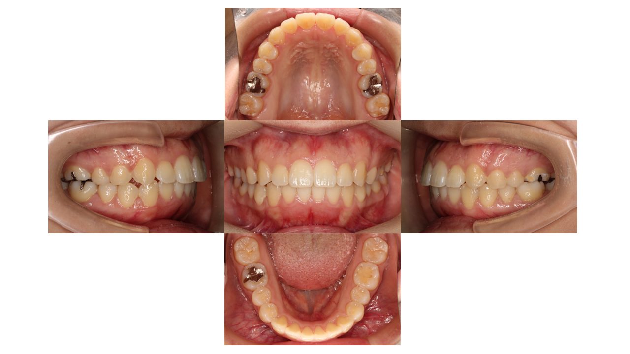 前歯の凸凹 八重歯 マウスピース矯正 インビザライン