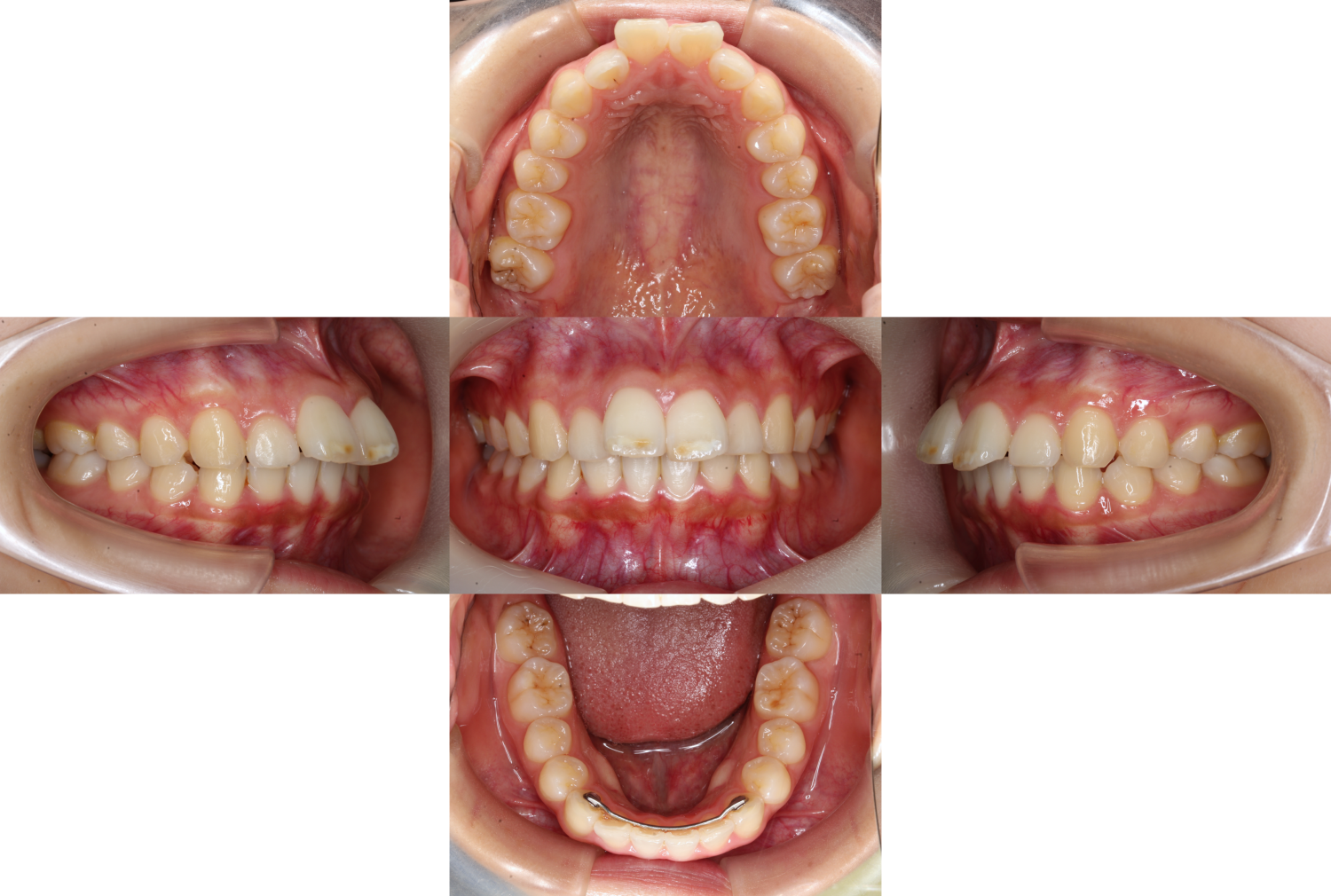 上顎前突・裏側矯正