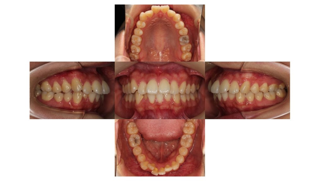 上下の凸凹　マウスピース矯正　インビザライン
