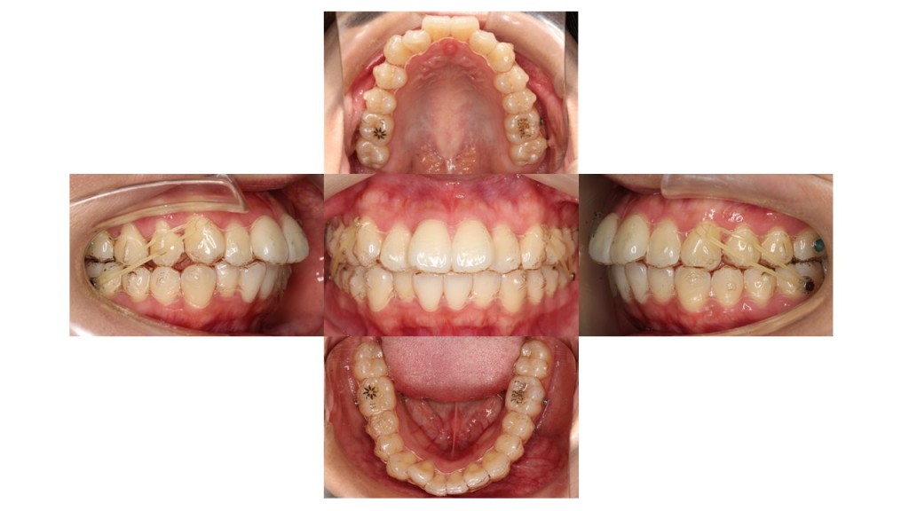 上下の凸凹　マウスピース矯正　インビザライン