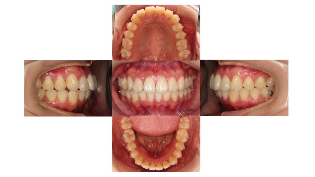 上下の凸凹　マウスピース矯正　インビザライン