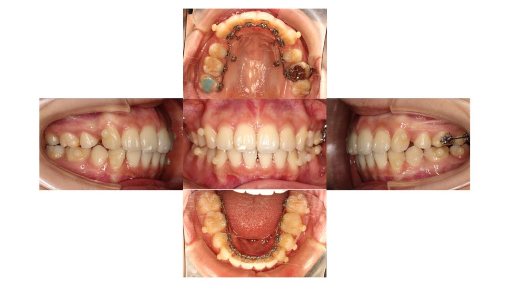 上の歯出ている、裏側矯正症例