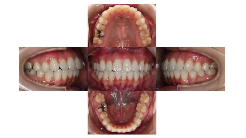 上顎前歯が出ている マウスピース矯正 インビザライン