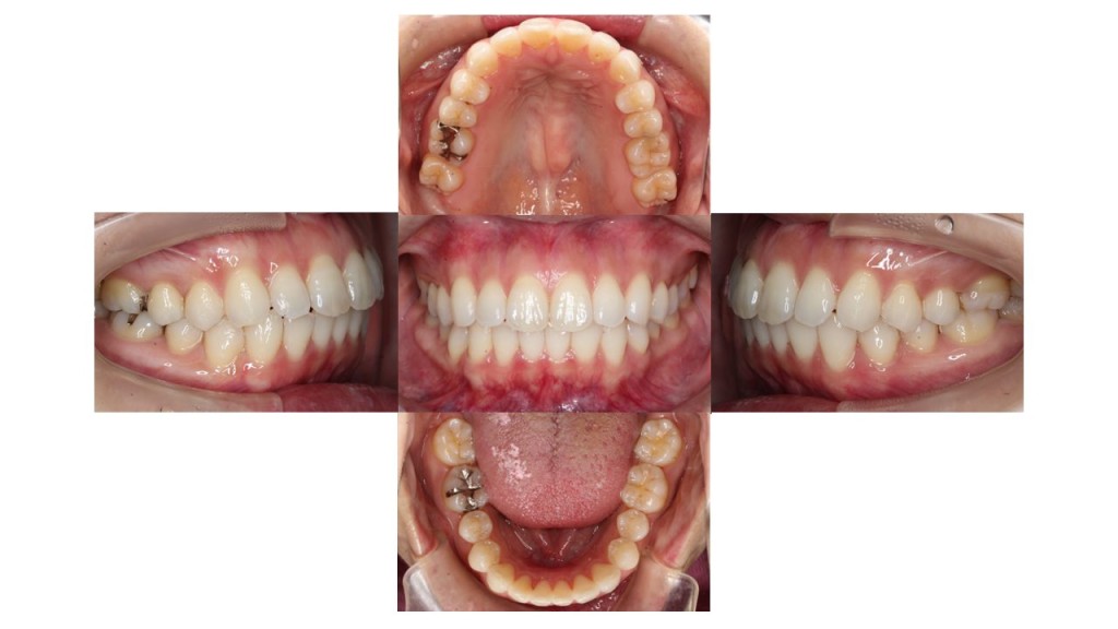 上顎前歯が出ている マウスピース矯正 インビザライン