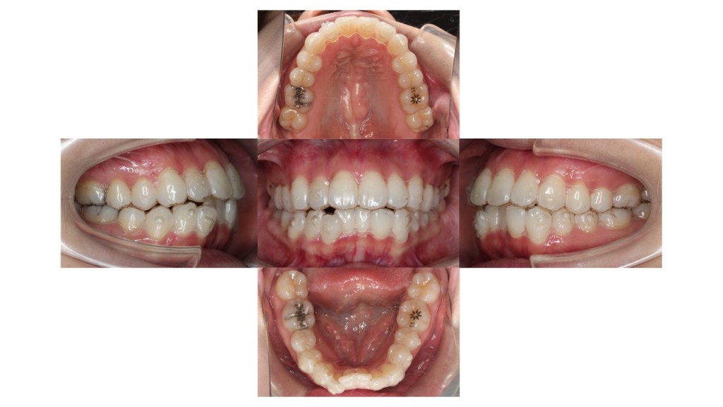 上顎前歯が出ている マウスピース矯正 インビザライン