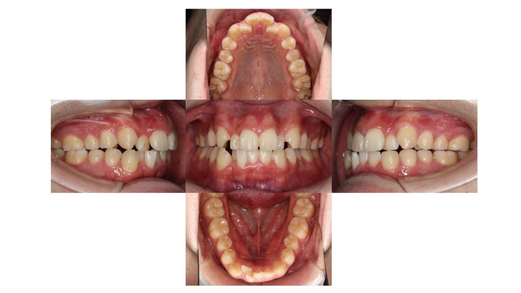 上下の凸凹　上顎前歯が出ている　マウスピース矯正　インビザライン