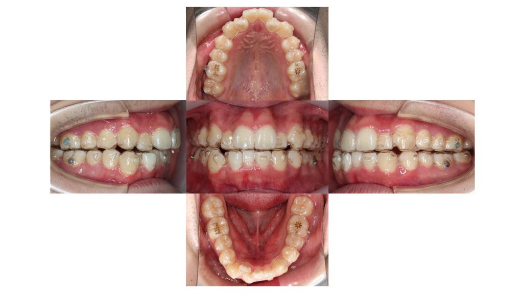 上下の凸凹　上顎前歯が出ている　マウスピース矯正　インビザライン
