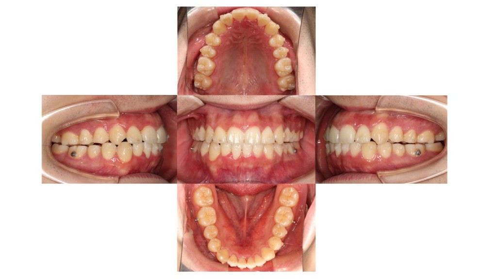 上下の凸凹　上顎前歯が出ている　マウスピース矯正　インビザライン