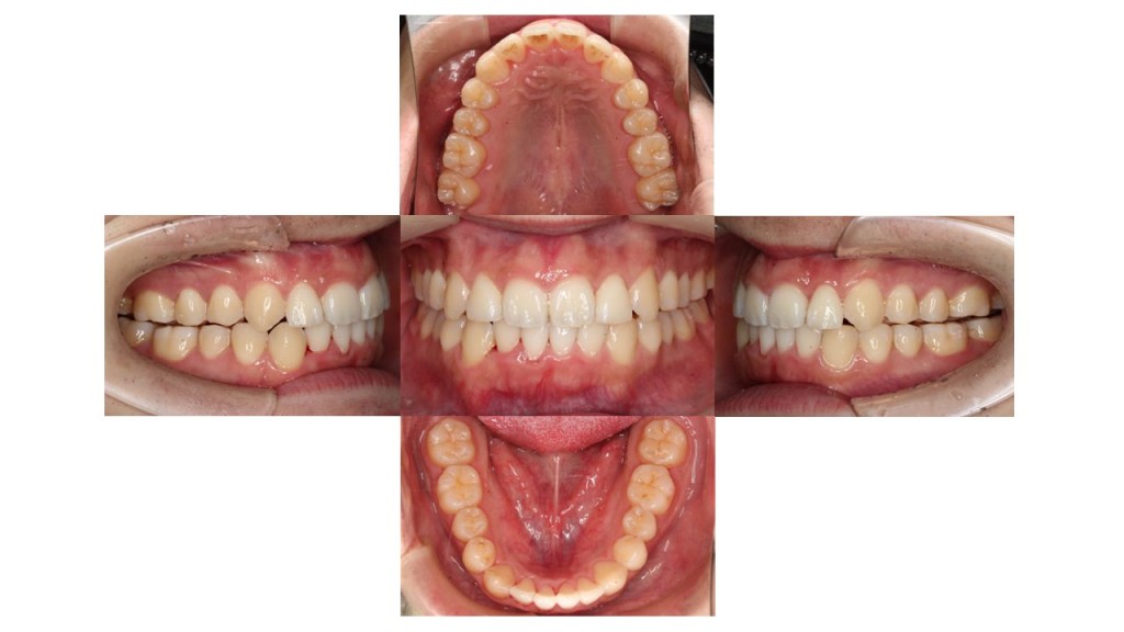 上下の凸凹　上顎前歯が出ている　マウスピース矯正　インビザライン