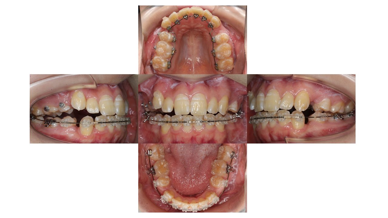 前歯凸凹 八重歯 裏側矯正 リンガル矯正