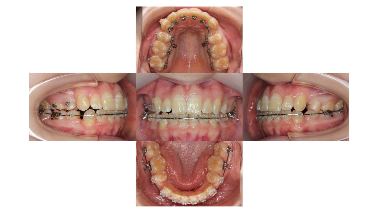 前歯凸凹 八重歯 裏側矯正 リンガル矯正