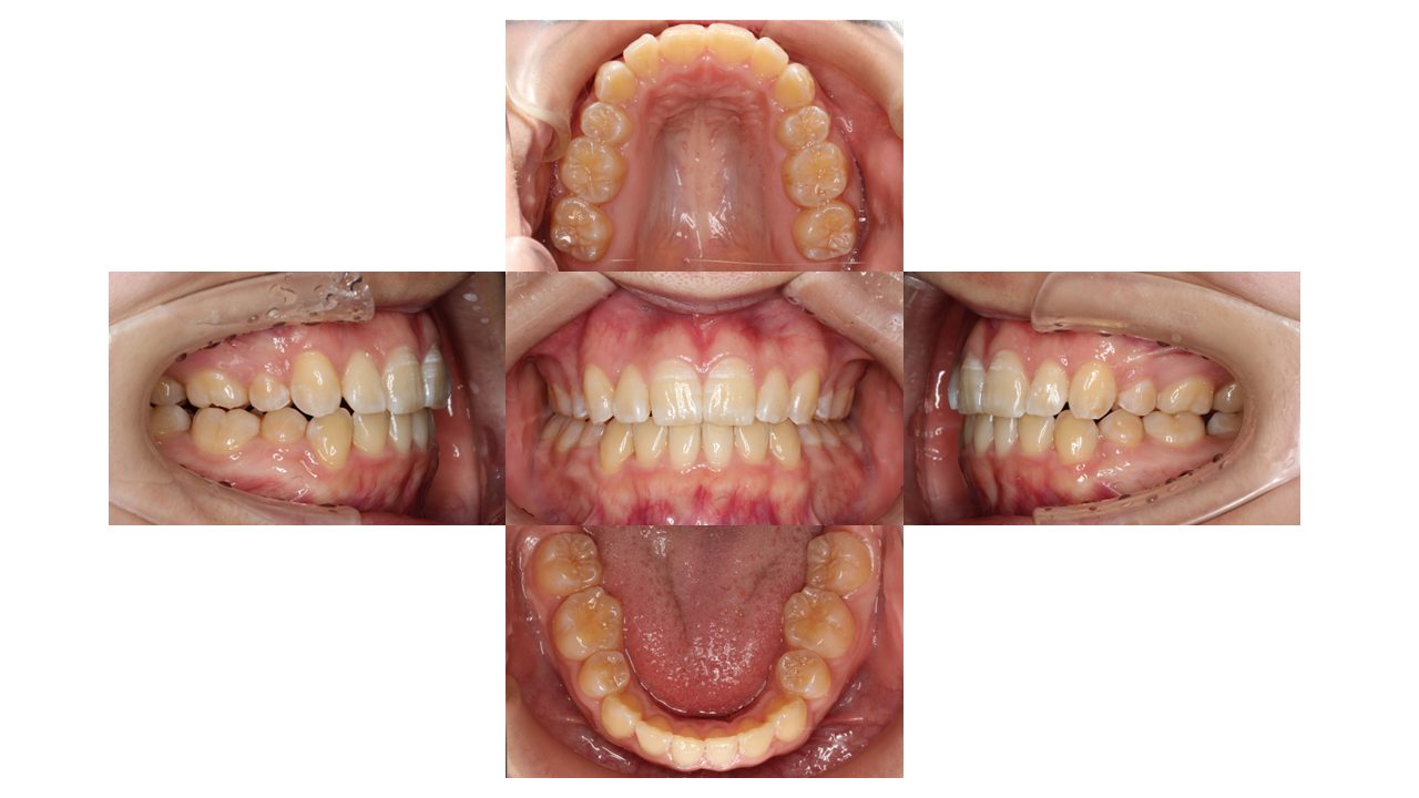 前歯凸凹 八重歯 裏側矯正 リンガル矯正