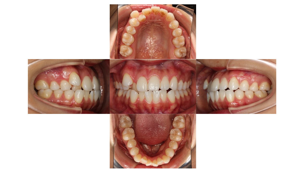 上下前歯の凸凹 インビザライン マウスピース矯正