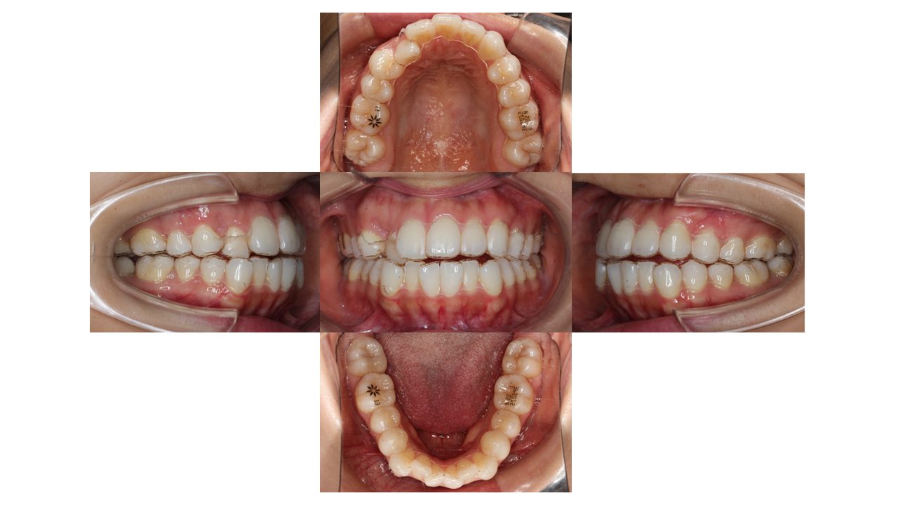 上下前歯の凸凹 インビザライン マウスピース矯正