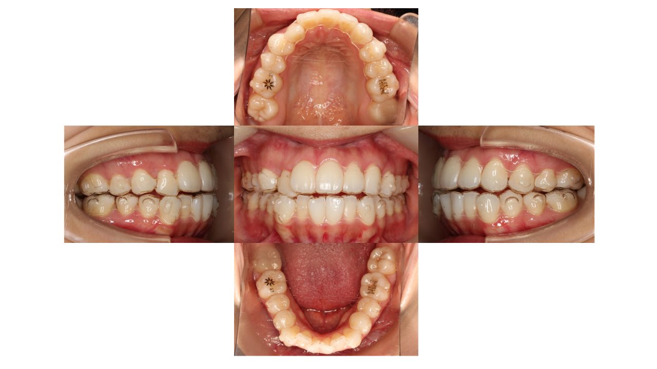 上下前歯の凸凹 インビザライン マウスピース矯正