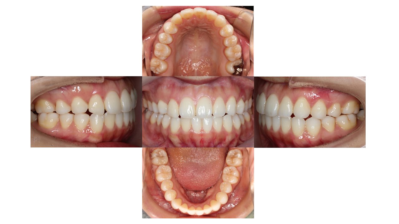上下前歯の凸凹 インビザライン マウスピース矯正