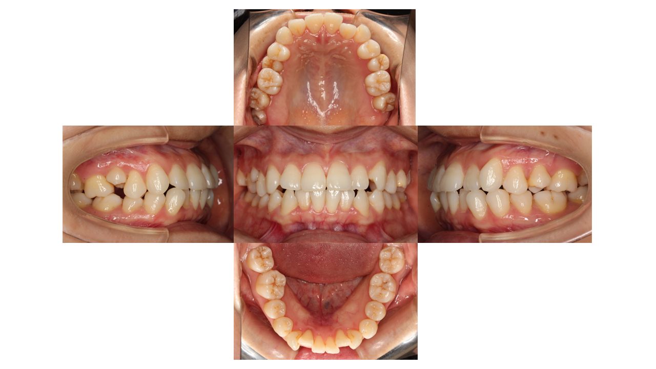 上下前歯の凸凹 インビザライン マウスピース矯正