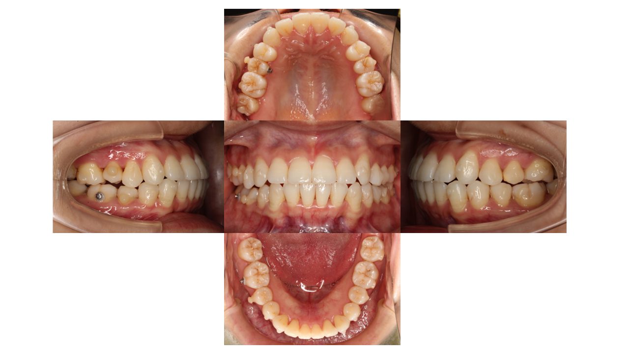 上下前歯の凸凹 インビザライン マウスピース矯正