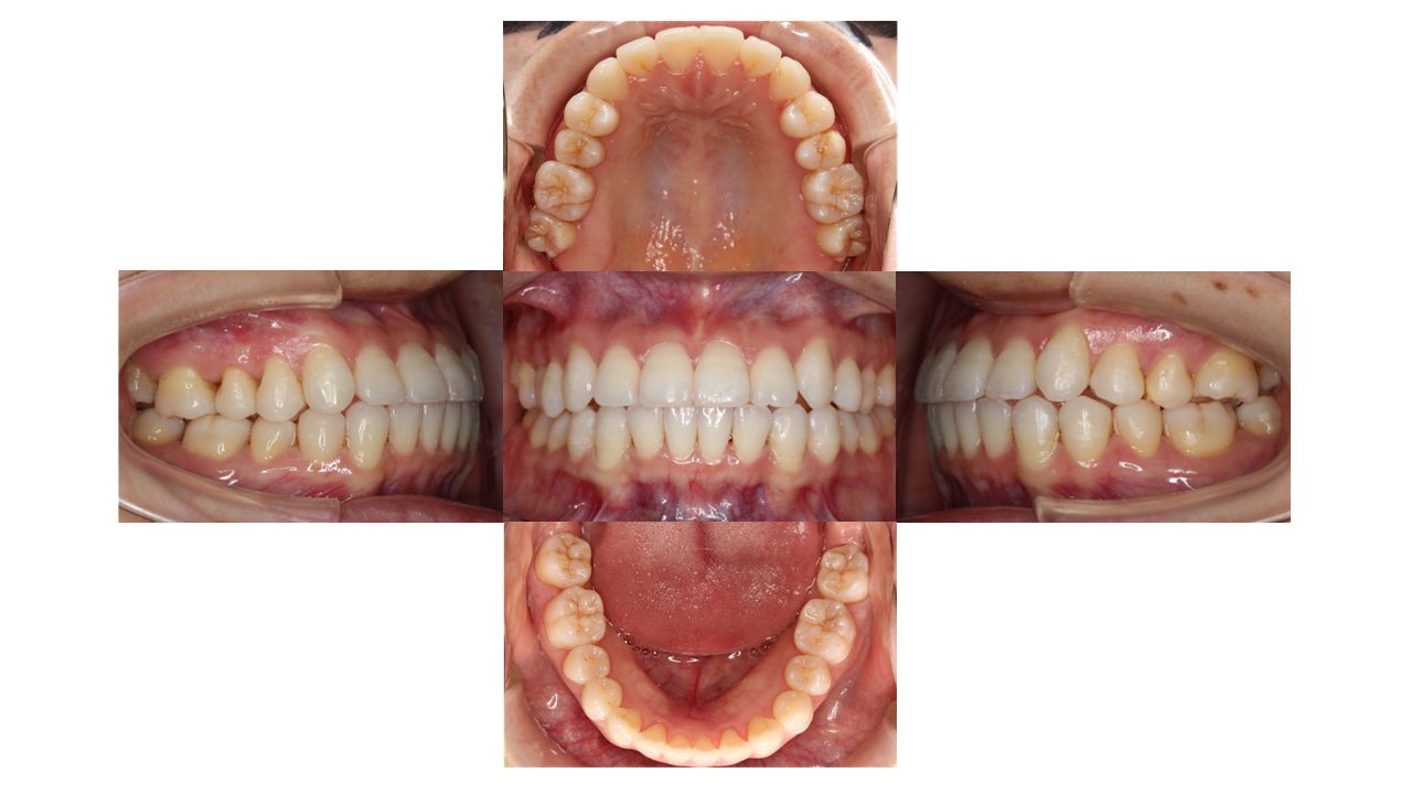 上下前歯の凸凹 インビザライン マウスピース矯正