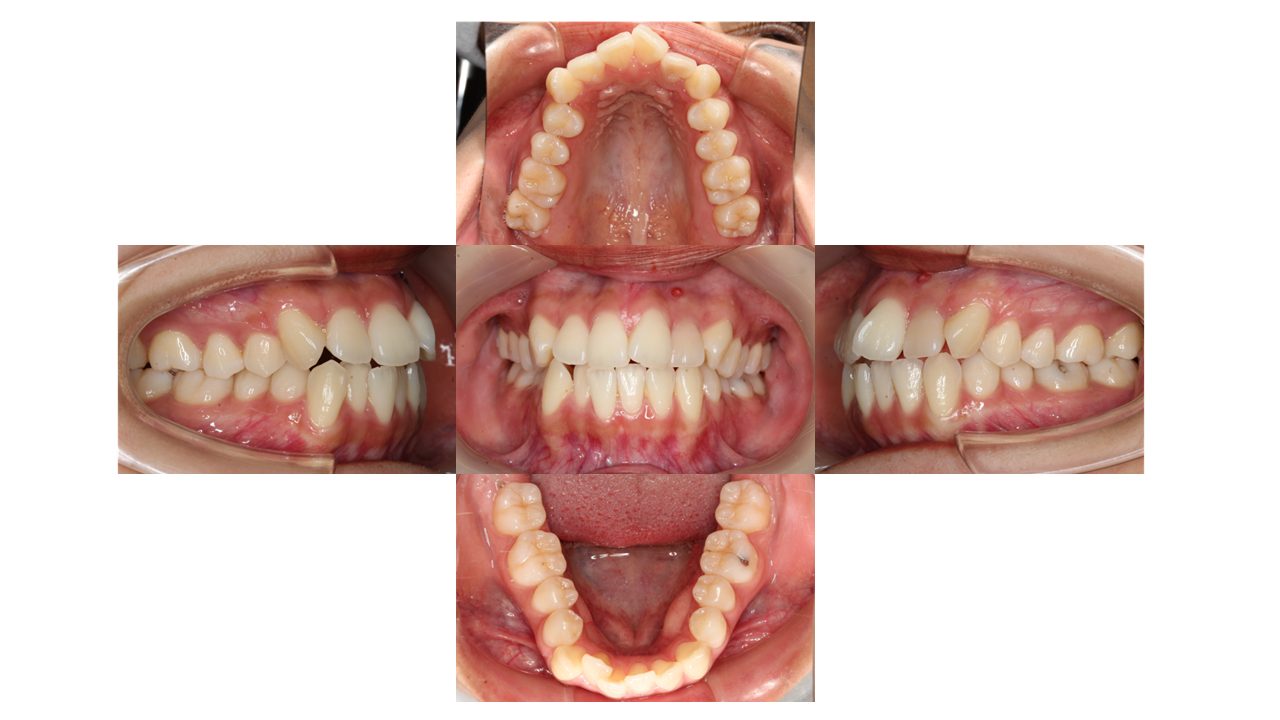 上下前歯の凸凹　インビザライン　マウスピース矯正