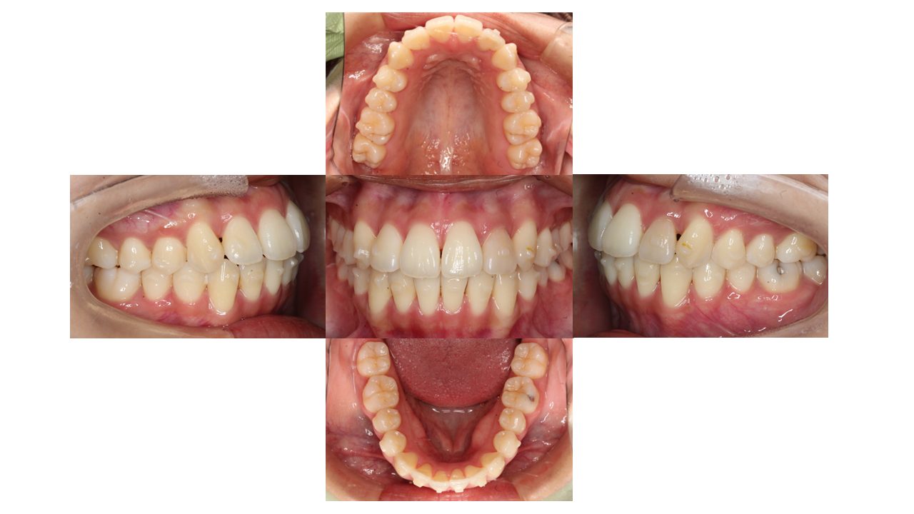 上下前歯の凸凹　インビザライン　マウスピース矯正