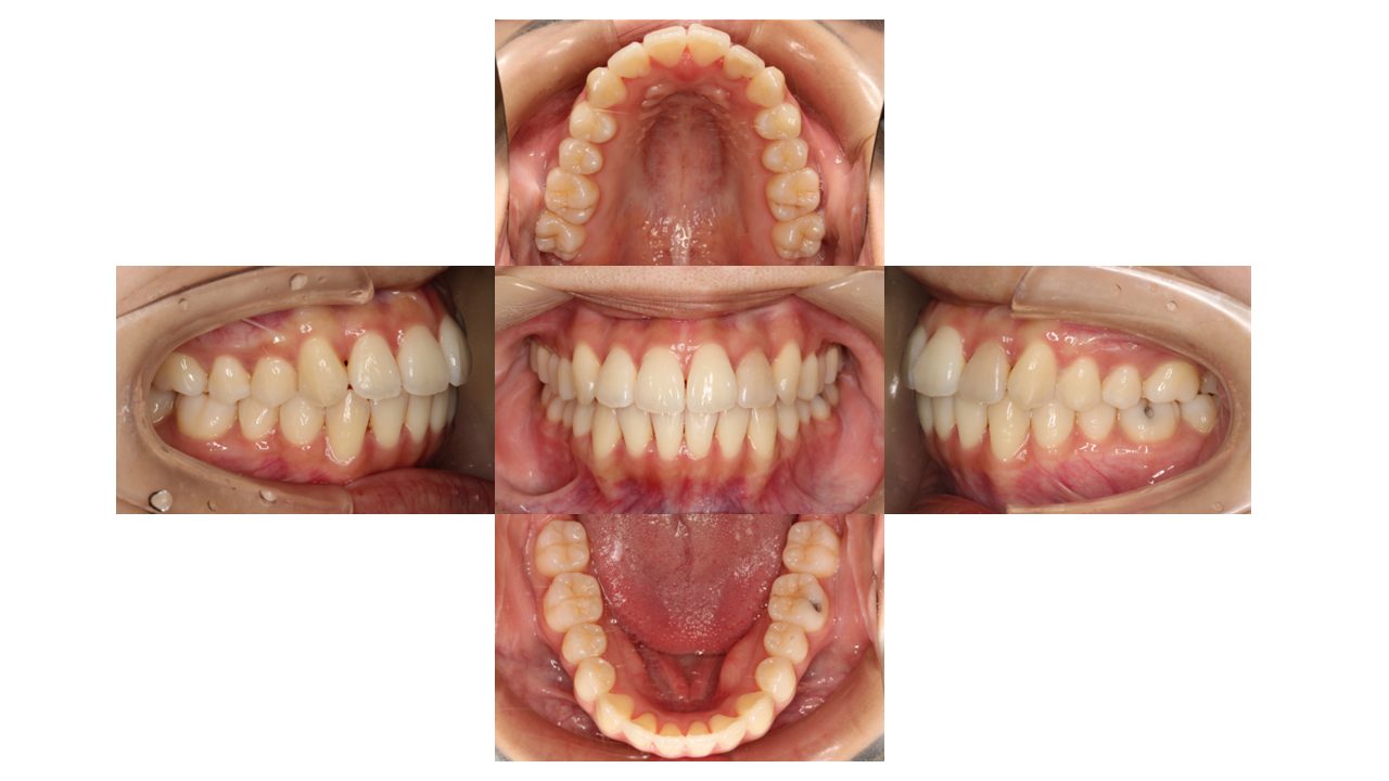 上下前歯の凸凹　インビザライン　マウスピース矯正